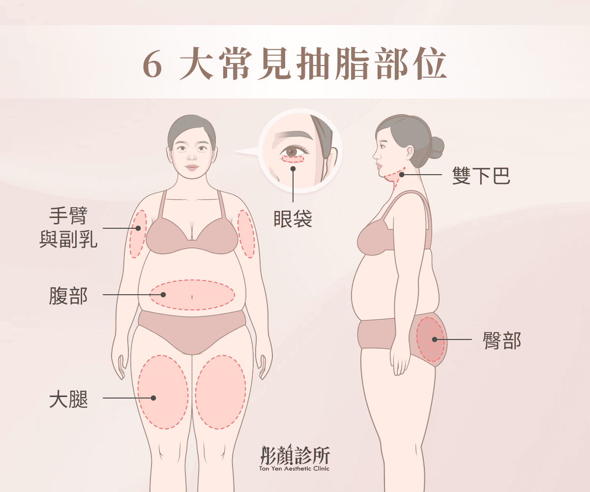 6大常見抽脂部位示意圖：手臂與副乳、腹部、大腿、雙下巴、臀部、眼袋